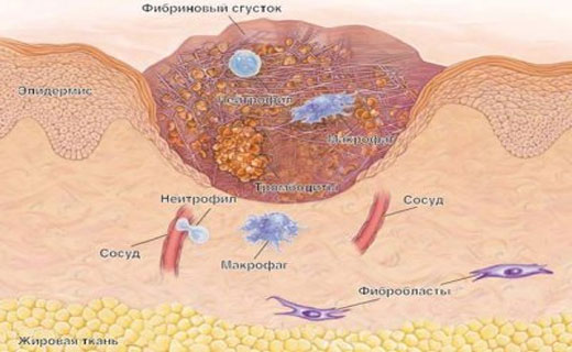 вульгарный псориаз