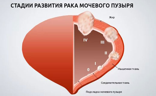 мочевой пузырь