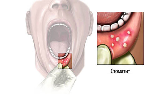 лечение хронического стоматита