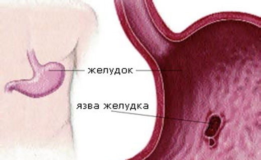 проявление язвы