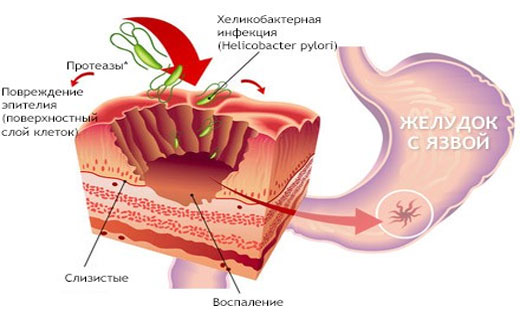 как избавиться от язвы