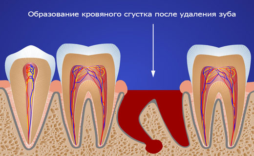 лечение после удалеия зуба