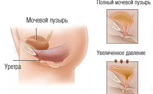 мочевой пузырь