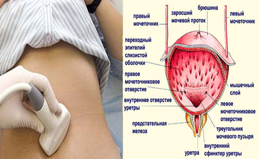 мочевой пузырь