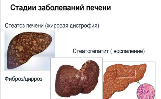 почки