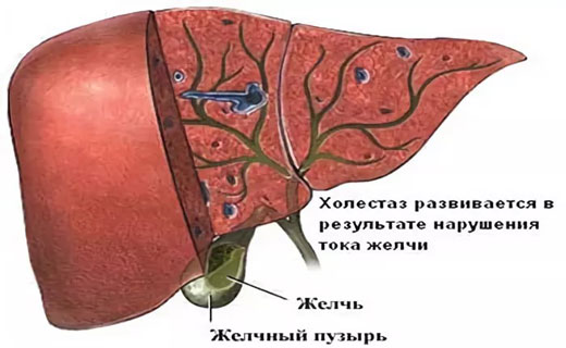 Как избавиться от застоя желчи