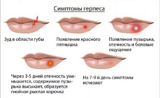 стадии герпеса