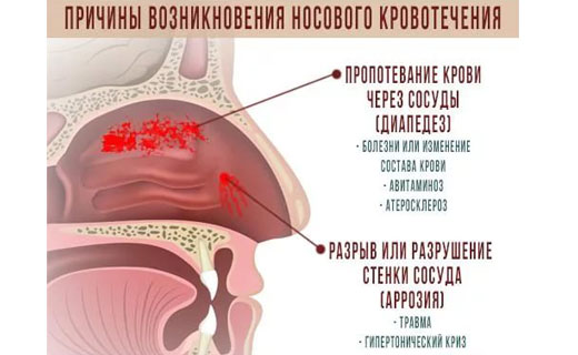 кровотечение из носа