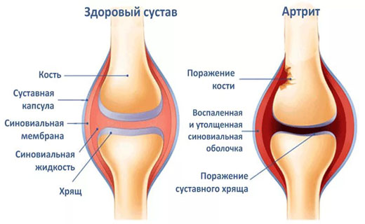 артрит коленный