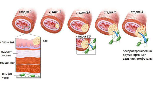 стадии развития рака