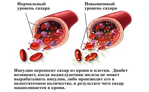 глюкоза в крови