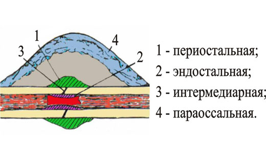 виды костной мозоли