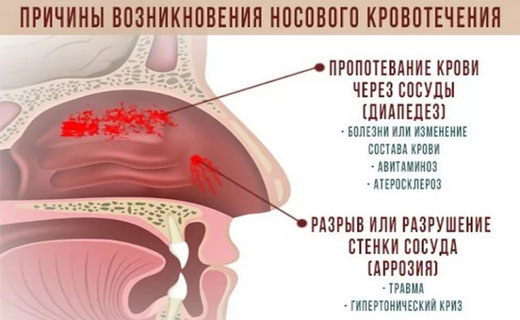 кровотечение носа