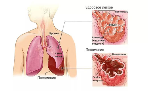 пневмония