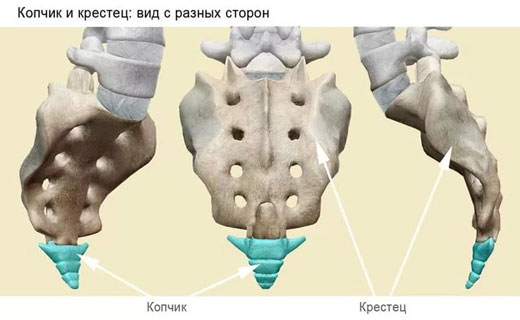 перелом копчика