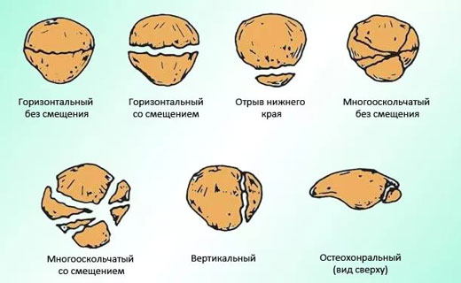 перелом надколенника