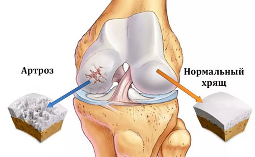 артроз коленного сустава