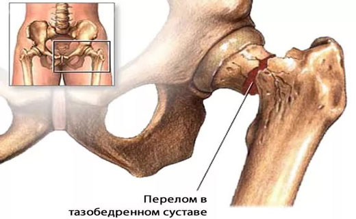 перелом тазобедренного сустава