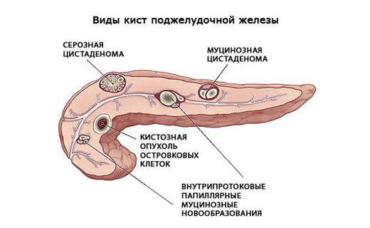 киста поджелудочной железы