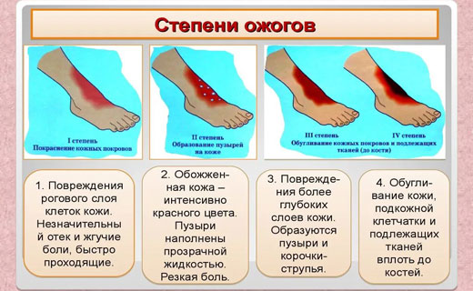 стадии ожогов