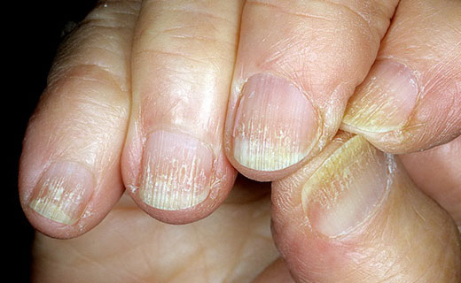 волнистые ногти от старости
