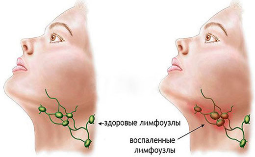 воспаленный лимфоузел