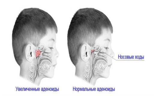 Увеличенные аденоиды у ребенка