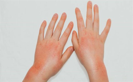 Аллергия у ребенка в виде прыщиков