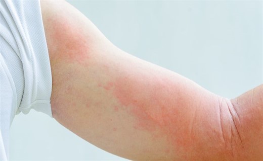 Виды кожной аллергии у детей