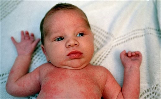 Аллергия на коже фото у детей