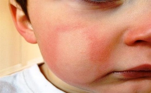 Аллергия на лице у ребенка фото