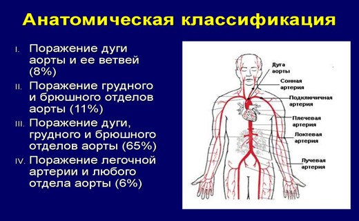 Неспецифический аортоартериит рекомендации