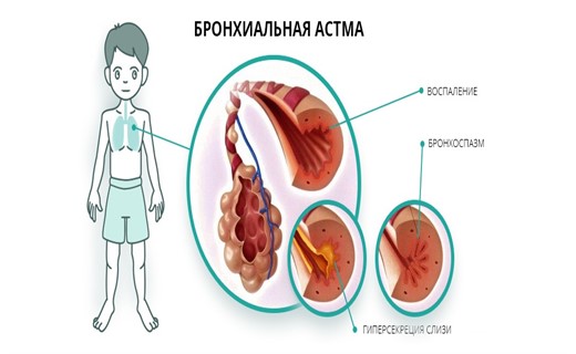 Ребенок больной астмой