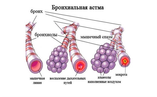 Как распознать астму у ребенка