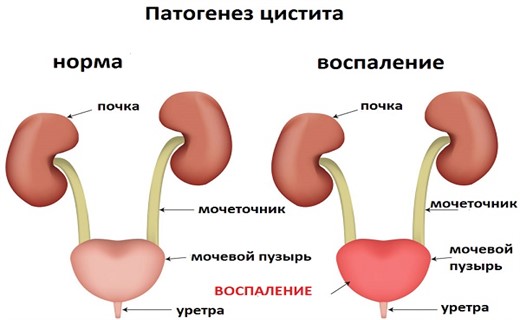 Как лечить цистит у детей?