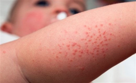 Дерматоз у детей - симптомы и лечение