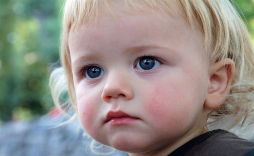 Диатез у детей: симптомы и лечение, профилактика