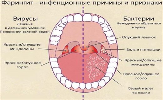 Фарингит у детей - симптомы и лечение