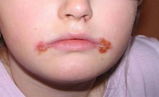 Фото герпетической инфекции у детей