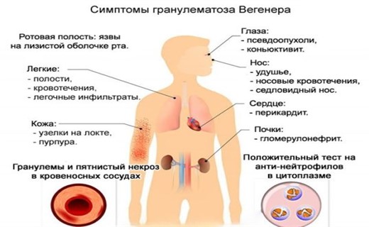 Гранулематоз вегенера картинки