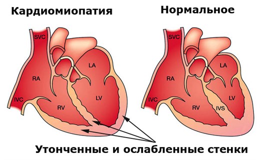 Функциональная кардиопатия