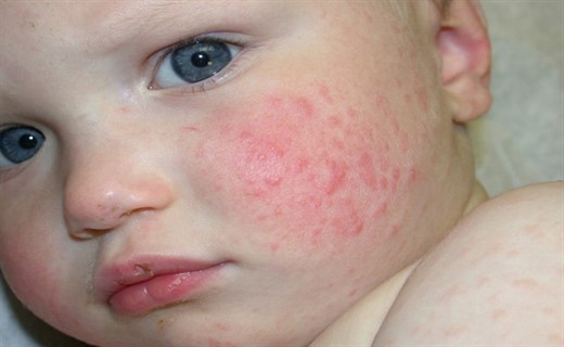 Крапивница у детей - симптомы и лечение