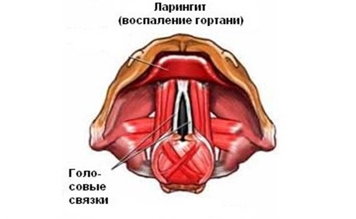 Приступ ларингита