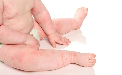 Аллергия в виде сыпи у ребенка