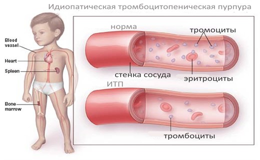 Тромбоцитопеническая пурпура у детей