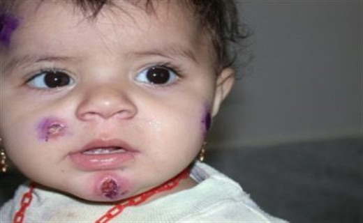 Лейшманиоз у человека - симптомы и лечение