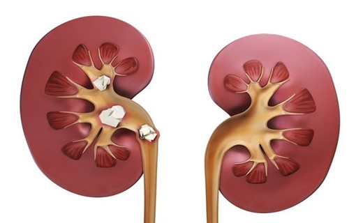 Мочекаменная болезнь у детей - причины, симптомы, диагностика