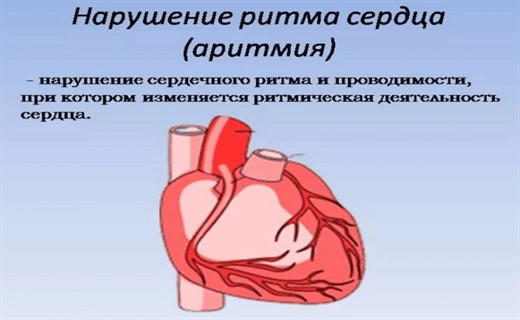 Болезнь нарушения сердечного ритма