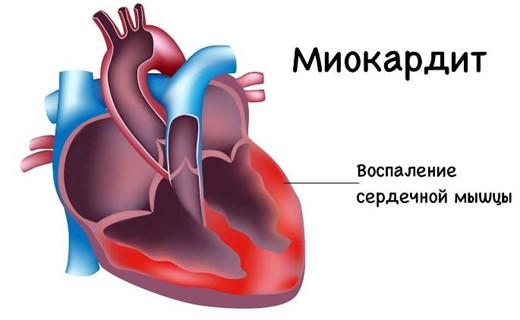 Миокардит сердца что это