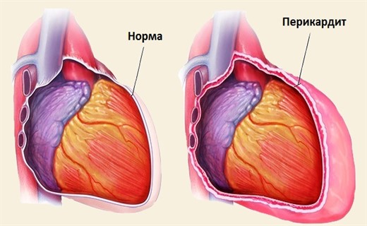 Перикардит сердца